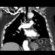 Thoracoplasty: CT - Computed tomography